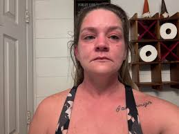 For the last 8 days I've started with insomnia. The itch is soooo bad. When  I do manage sleep it's short spats. So now I'm tired, itchy and grouchy.  It's 2.30 a.m,