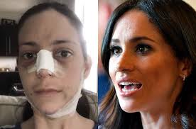 See more of klaudia halejcio on facebook. Chciala Wygladac Jak Meghan Markle Na Operacje Plastyczne Wydala Niemal 100 Tysiecy Zlotych
