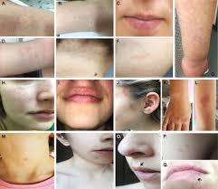 Phenotype of CM-AVM2 caused by variants in EPHB4: how much overlap with  hereditary hemorrhagic telangiectasia (HHT)?