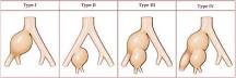 Image result for icd 10 code for iliac aneurysm
