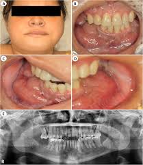 Primary manifestation of HIV-related Burkitt lymphoma in the oral and  maxillofacial regions