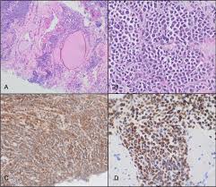 Clyde & co (scotland) llp. Merkel Cell Carcinoma Of The Maxillary Sinus An Unusual Presentation Of A Common Tumor Springerlink