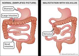 This is the largest part of the digestive system. Congenital Malformations Of The Gastrointestinal Tract