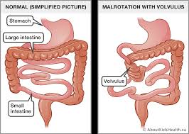 Oct 02, 2018 · for a colostomy, the surgeon will connect a portion of the large intestine, the colon, to an opening in the abdominal wall. Congenital Malformations Of The Gastrointestinal Tract