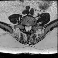'die lehre yom gesichtsfeld geht, wie so viele grundlegende untersuchungen, auf albrecht von graefe zuriick. Arachnoiditis Radiology Reference Article Radiopaedia Org