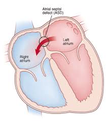 Image result for Atrial Septal Defect