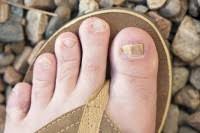 Voetschimmel, eczeem, andere schimmels infecties rond de teennagels of genezen. Zwarte Nagel Oorzaak Van Zwarte Vlekken Onder De Nagel Mens En Gezondheid Aandoeningen