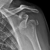 Image result for Shoulder Dislocation