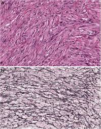 Malignant means they are capable in comparison to epithelial cells, sarcomatoid cells have a distinctive, elongated spindle shape that. Pleural Mesothelioma Classification Update Springerlink