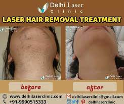 Since most aesthetic procedures need multiple treatments before seeing results, such as laser tattoo removal, many clinics tend to offer treatment. Laser Hair Removal Results Laser Hair Removal Results Laser Hair Hair Removal