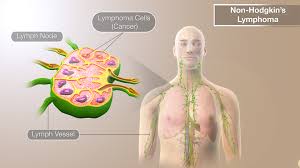 Image result for Lymphoma