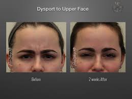 That said, if you use our site, you could find deals on dysport near you for as. Dysport New Orleans New Orleans Center For Aesthetic And Plastic Surgery