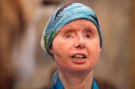 Transformasi Wanita Diserang Simpanse Hingga Wajah Rusak Tak Berbentuk