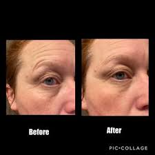 After a few minutes, it dries and the results are incredible. Peter Thomas Roth Instant Firmx Temporary Face Tightener Amazon