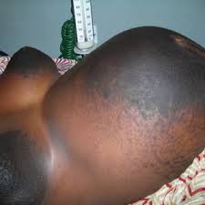 We did not find results for: Pdf Extensive Hyperpigmentation During Pregnancy A Case Report