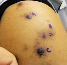 When it does rain, it comes in short bursts. Brown Black Papulonodules On The Arm Mdedge Dermatology