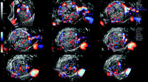 Ovarian Dysgerminoma Ovarian Corpus Luteum Ovarian Cyst