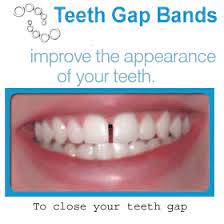 Fixing a gap between the front teeth. Teeth Gap Bands Close Gapped Teeth