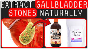 Gallstones cause problems when they block any of the ducts carrying bile from the liver or this procedure requires only an overnight hospital stay and a week of recovery at home. Gallbladder Stones Naturally At Home Do Not Operate Gallbladder Hindi Youtube