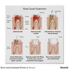 Root Canal Treatment Poster Zazzle Com Root Canal Treatment Root Canal Dental Crowns
