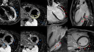 Treatment for myocarditis depends on the cause. Myocarditis And Covid Vaccines Where Do We Stand Medpage Today
