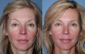 Blepharoplasty New York, NY