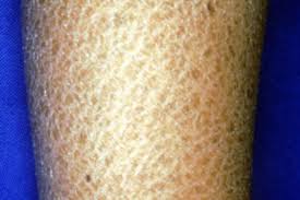 Image result for Dry Skin