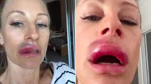 Lip injections: Mum's horror reaction to cosmetic procedure