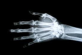 Image result for Interphalangeal Dislocation