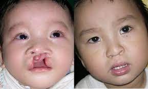 Nearly 2 decades from infancy to adulthood are necessary for the completion of care and subsequent evaluation of functional and aesthetic results. Photo Gallery International Children S Surgical Foundation
