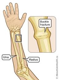 Check spelling or type a new query. Fracture How To Treat A Buckle Fracture Of The Distal Radius