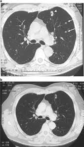 prostate carcinoma (most common) breast carcinoma (may be mixed) transitional cell carcinoma (tcc) carcinoid. Case Study Management Of Advanced Prostate Cancer With Soft Tissue Metastases Prostate Cancer And Prostatic Diseases
