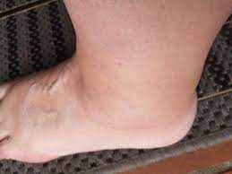 Zunächst erfasst der arzt die krankengeschichte (anamnese). Umgeknickt Und Im Urlaub In Danemark