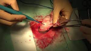 仮性包茎の根元切開包茎手術②/４ 皮膚切開、切除、止血 - YouTube