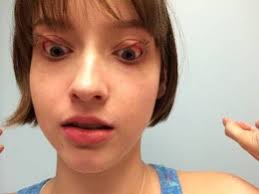 Joint hypermobility/EDS in ME/CFS