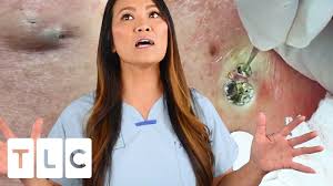 Check spelling or type a new query. The Award For The Biggest Blackhead A Juicy Cyst Dr Pimple Popper This Is Zit Youtube