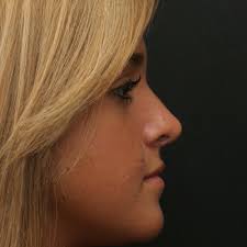 TOP 10 BEST Mole Removal near Auburn, MA