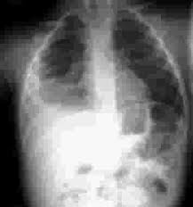 Manusia akan menghidap pelbagai penyakit, khususnya respirasi akibat menghidu udara yang tercemar. Pneumonia Pada Anak Gejala Penyebab Dan Cara Mencegahnya