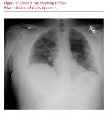 Nasal cannulas are medical devices used when people are unable to get sufficient oxygen to keep their body functioning optimally, whether that's due to a condition like. High Flow Nasal Cannula Oxygenation Revisited In Covid 19 Cfr Journal