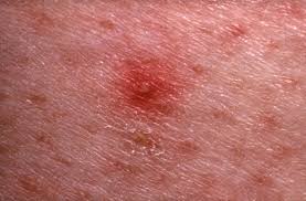 Dermatofibroma is a blemish that typically develops on the lower legs in women, although they can happen anywhere on the body. Skin Rash 7 Causes Of Red Spots And Bumps With Pictures Allure