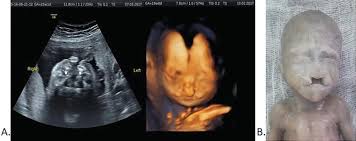 Congenital Abnormalities Of The Fetal Face Intechopen