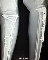 We did not find results for: Orthopedic Surgery Wikipedia