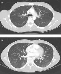 Une intradermoréaction à la tuberculine (idr) ou un dosage de quantiferon peuvent permettre de découvrir une tuberculose latente. Le Zebre Du Troupeau Covid Forum Medical Suisse