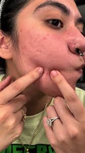 Whitehead Extraction Tips for Clearer Skin