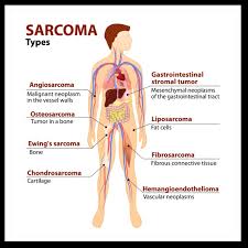 Cancer that has started in one place can spread to and invade other parts of the body. Sarcoma West Cancer Center