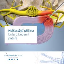 Image result for vyhřezlá ploténka