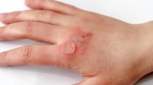 Image result for Skin Tear