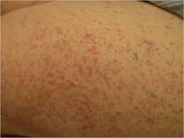 Image result for Urticaria pigmentosa children