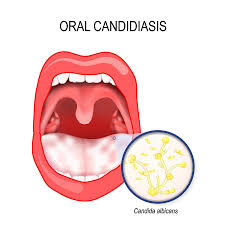 Image result for oral thrush symptoms roof of the mouth