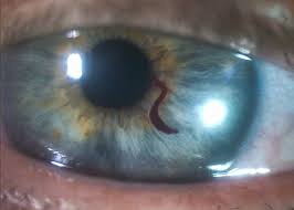 Image result for Hyphema